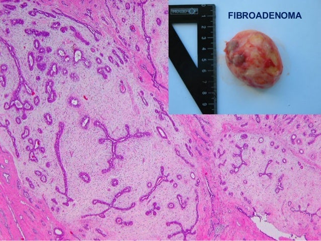 papillomatosis of the breast Teen masturbation photo